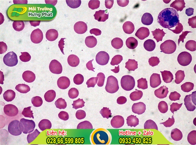 Lượng bạch cầu &aacute;i toan tăng cao